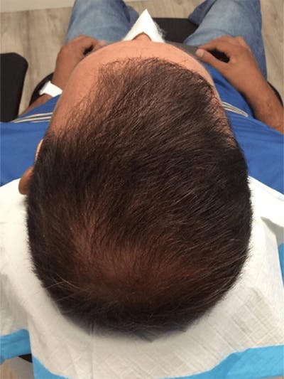 Male Hair Transplants Before & After Gallery - Patient 108592 - Image 2