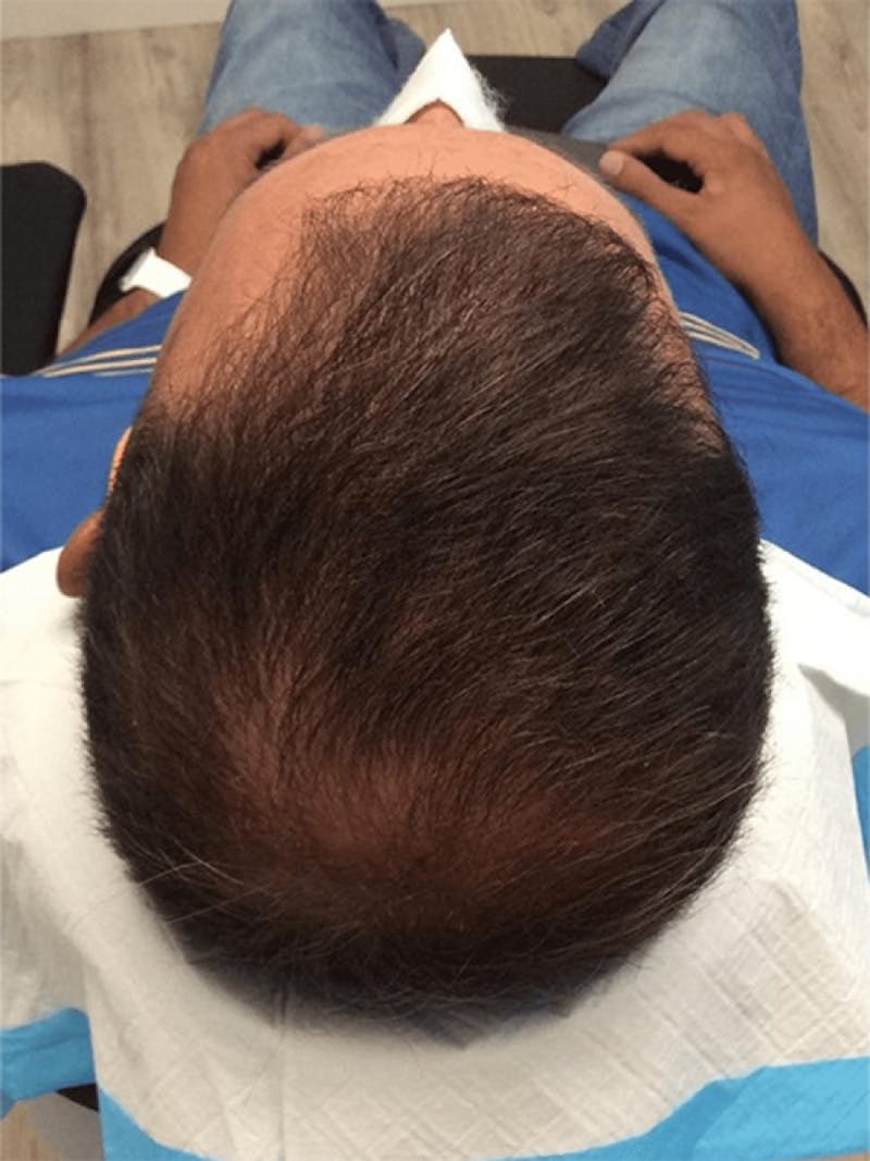 Male Hair Transplants Before & After Gallery - Patient 108592 - Image 2