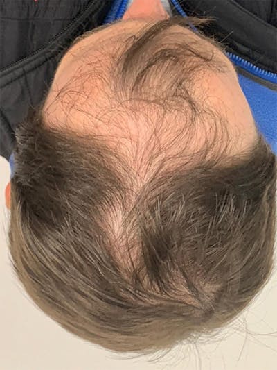 Male Hair Transplants Before & After Gallery - Patient 313739 - Image 1