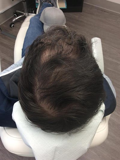 Male Hair Transplants Before & After Gallery - Patient 313739 - Image 2