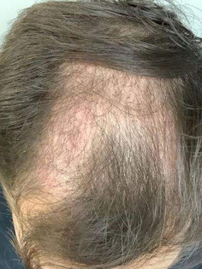 Male Hair Transplants Before & After Gallery - Patient 900952 - Image 1