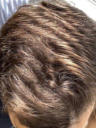 Male Hair Transplants Before & After Gallery - Patient 900952 - Image 2