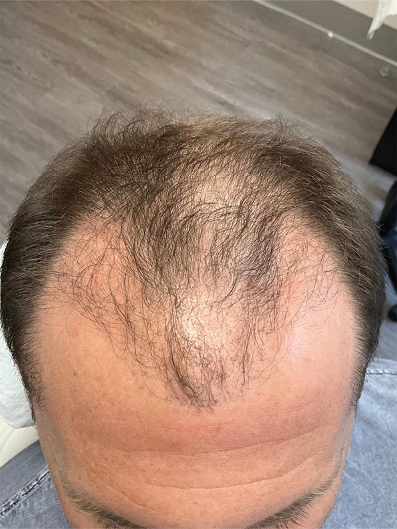 Male Hair Transplants Before & After Gallery - Patient 424061 - Image 1