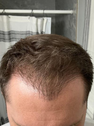 Male Hair Transplants Before & After Gallery - Patient 424061 - Image 2