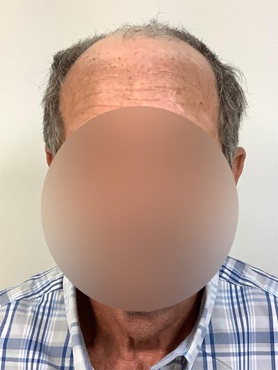 Male Hair Transplants Before & After Gallery - Patient 287422 - Image 1