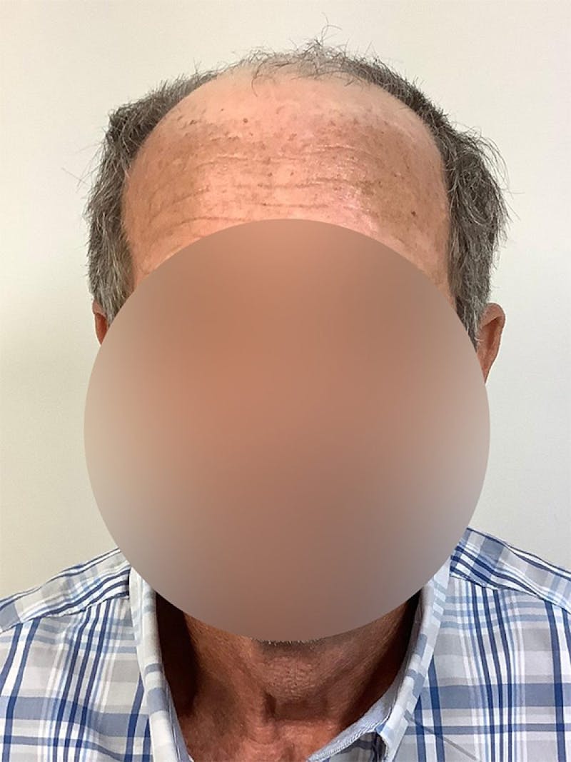 Male Hair Transplants Before & After Gallery - Patient 287422 - Image 1