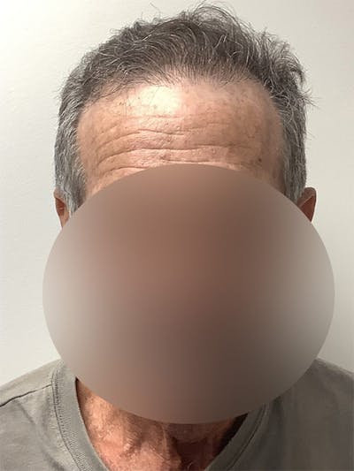 Male Hair Transplants Before & After Gallery - Patient 287422 - Image 2
