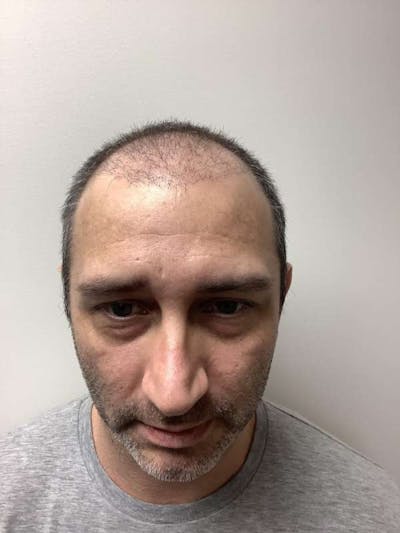 Male Hair Transplants Before & After Gallery - Patient 278603 - Image 1
