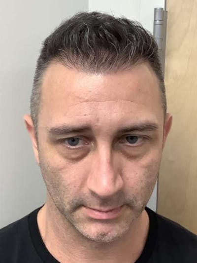 Male Hair Transplants Before & After Gallery - Patient 278603 - Image 2