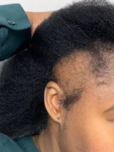 Female Hair Transplants Before & After Gallery - Patient 351614 - Image 1