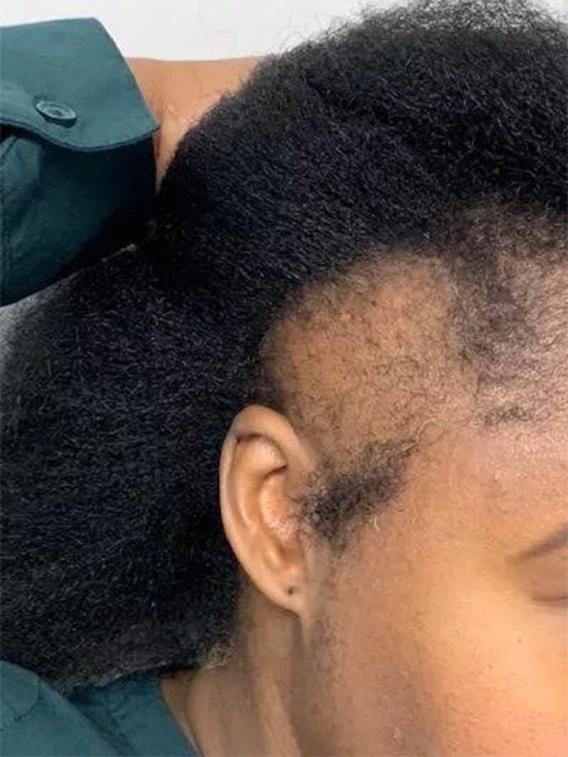 Female Hair Transplants Before & After Gallery - Patient 351614 - Image 1