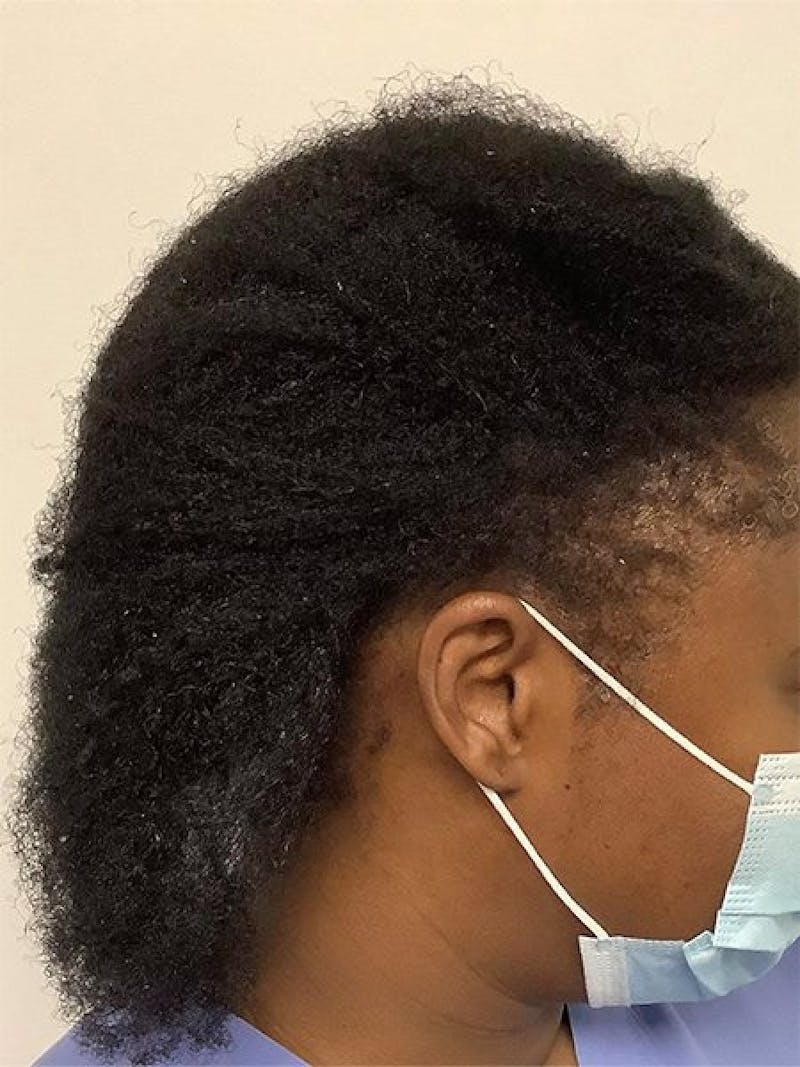 Female Hair Transplants Before & After Gallery - Patient 351614 - Image 2