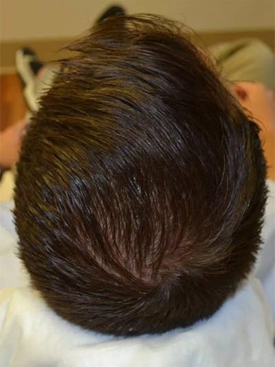 Male Non-Surgical Before & After Gallery - Patient 294964 - Image 1