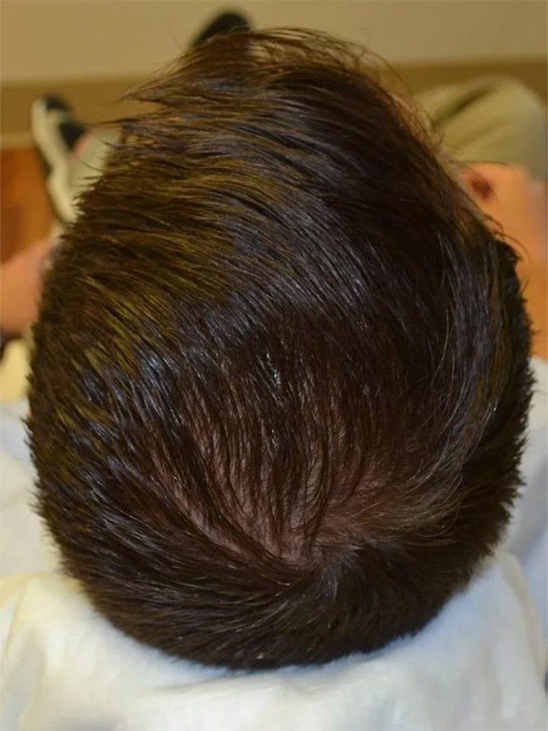 Male Non-Surgical Before & After Gallery - Patient 294964 - Image 1