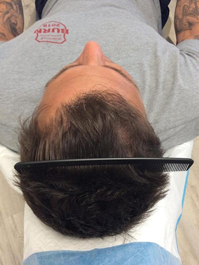 Male Non-Surgical Before & After Gallery - Patient 172084 - Image 1