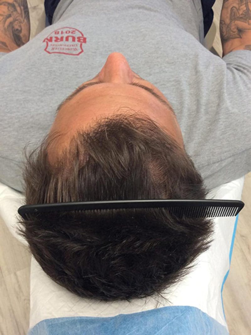 Male Non-Surgical Before & After Gallery - Patient 172084 - Image 1