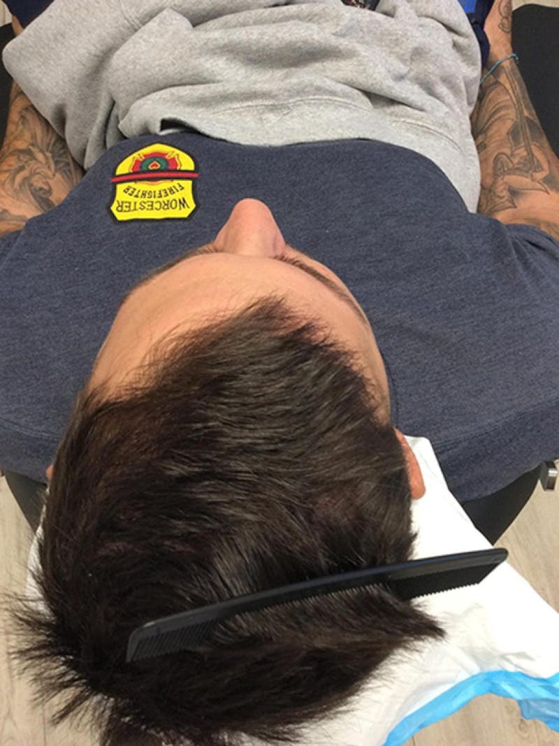 Male Non-Surgical Before & After Gallery - Patient 172084 - Image 2