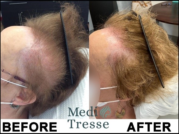 Frontal Fibrosing Alopecia (FFA) before and after