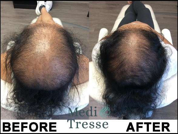 Lichen Planopilaris (LPP) before and after