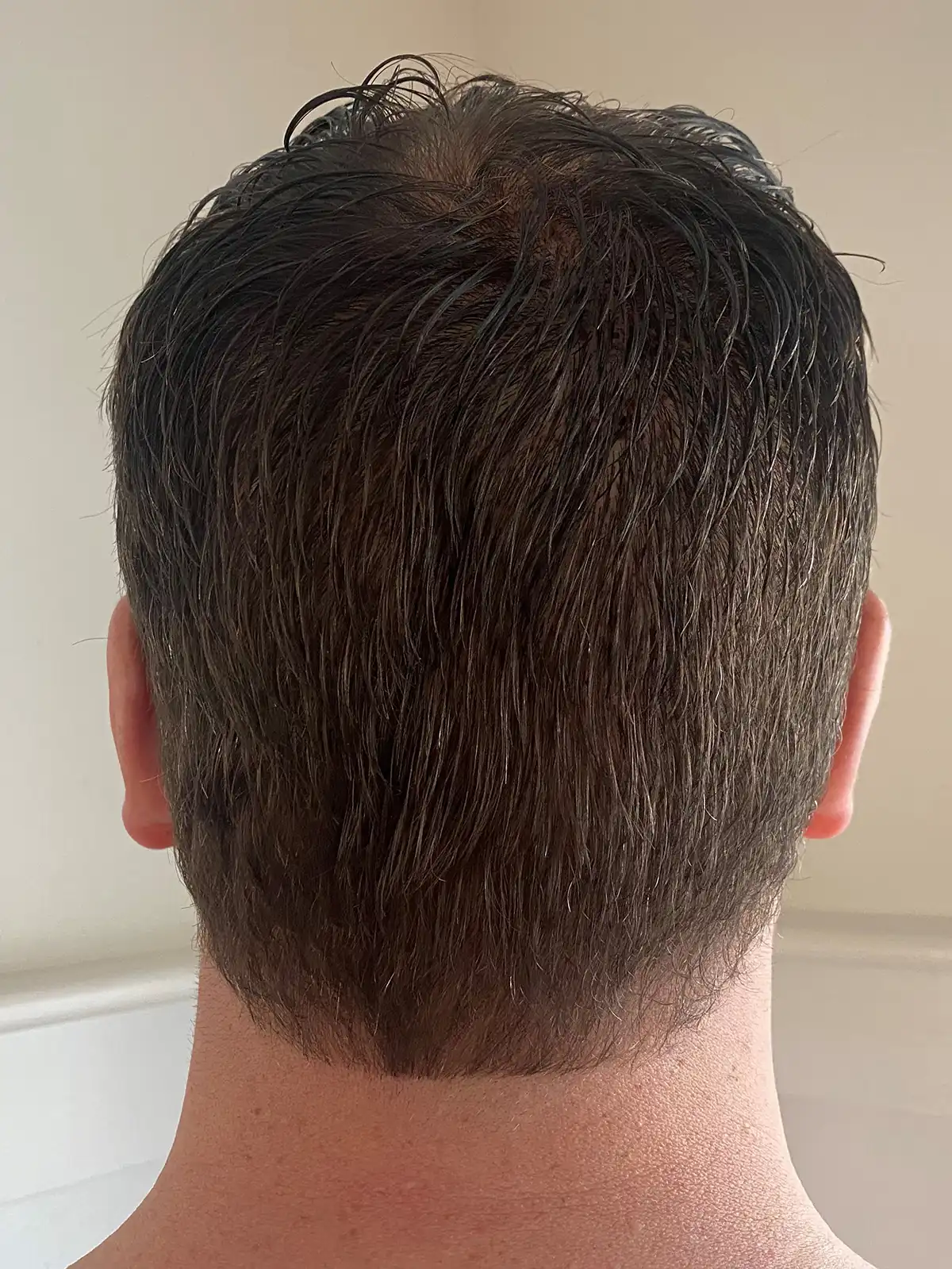 Back of male patient's head 24 hours after receiving a no shave PFE treatment