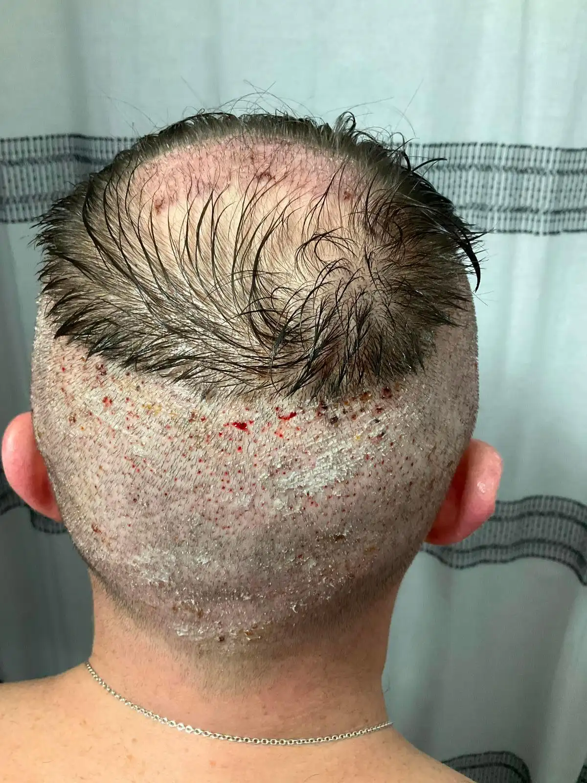 back of male patient's head 24 hours after receiving a shave FUE treatment