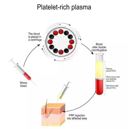 prp infographic