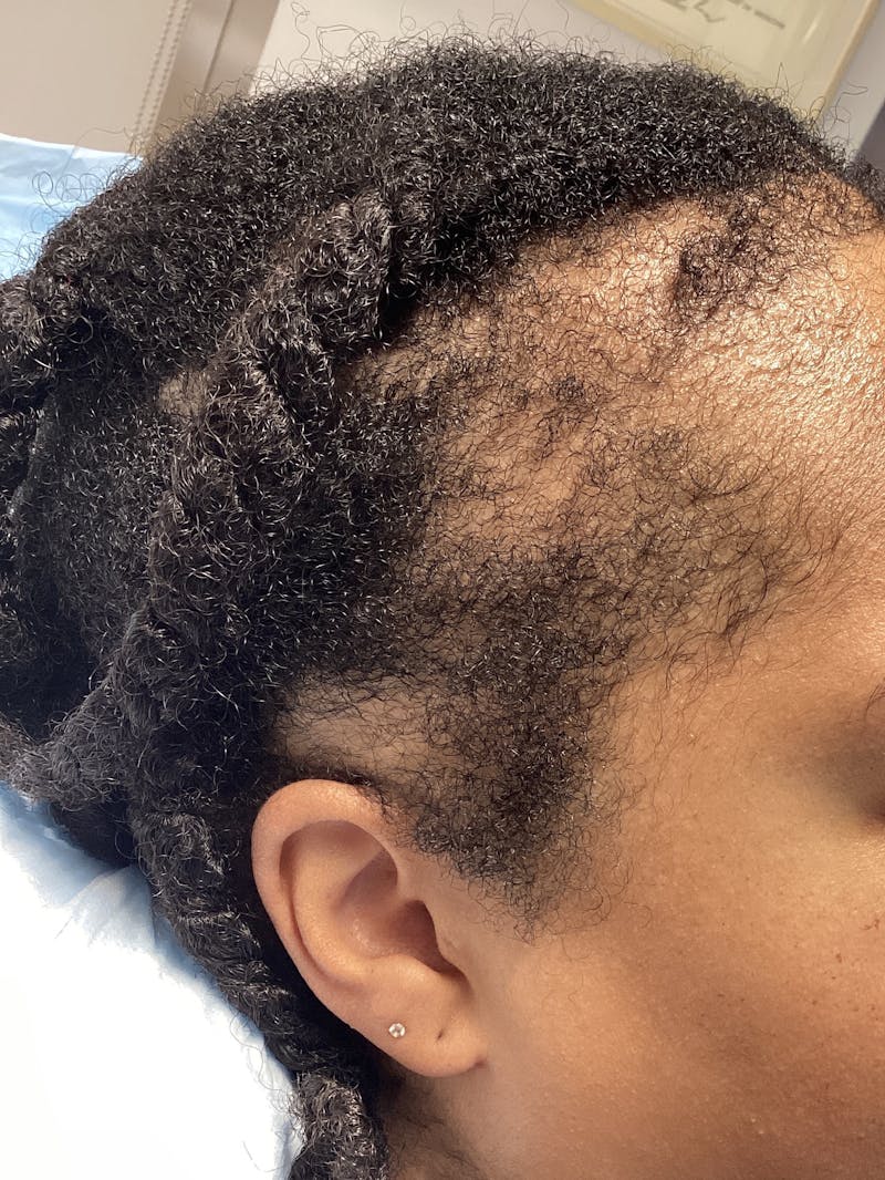 Traction Alopecia Before & After Gallery - Patient 267147 - Image 2