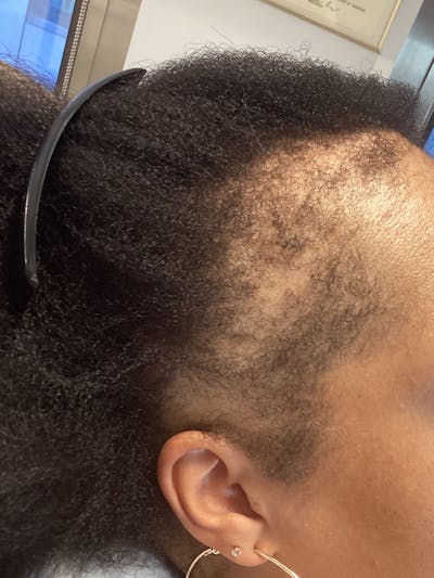 Traction Alopecia Before & After Gallery - Patient 267147 - Image 1