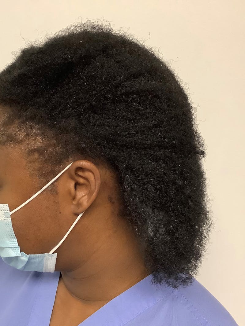 Traction Alopecia Before & After Gallery - Patient 389176 - Image 2