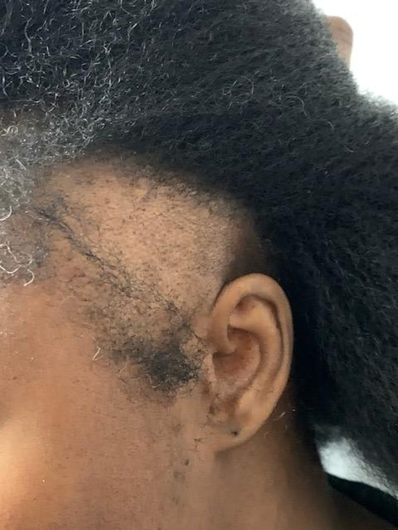 Traction Alopecia Before & After Gallery - Patient 389176 - Image 1