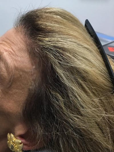 Telogen Effluvium Before & After Gallery - Patient 412046 - Image 2