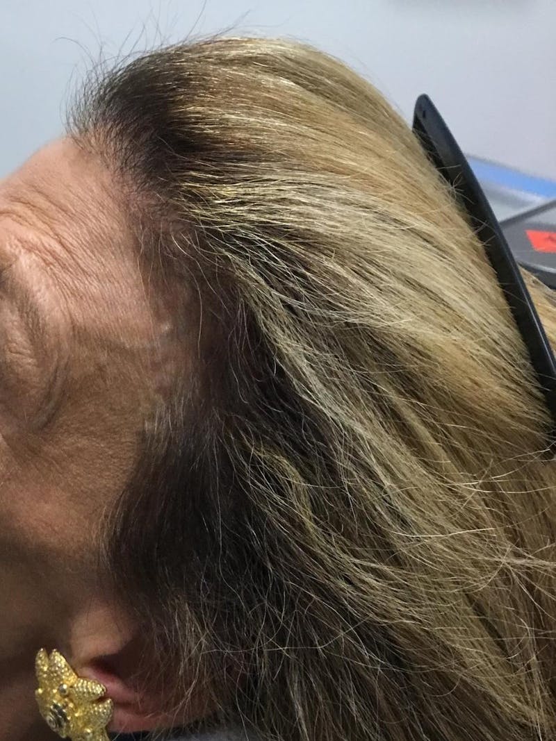 Low Level Laser Therapy Before & After Gallery - Patient 419726 - Image 2