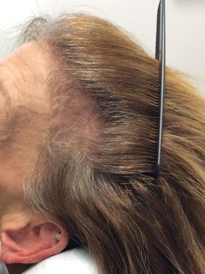 Telogen Effluvium Before & After Gallery - Patient 412046 - Image 1
