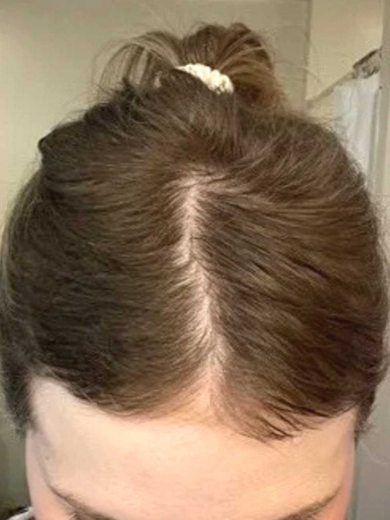Telogen Effluvium Before & After Gallery - Patient 164919 - Image 2