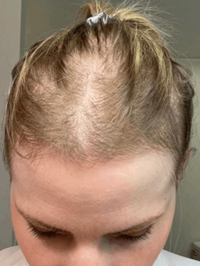 Telogen Effluvium Before & After Gallery - Patient 164919 - Image 1