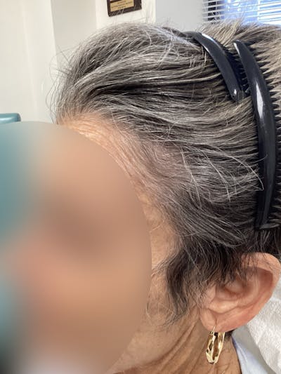Telogen Effluvium Before & After Gallery - Patient 385900 - Image 2