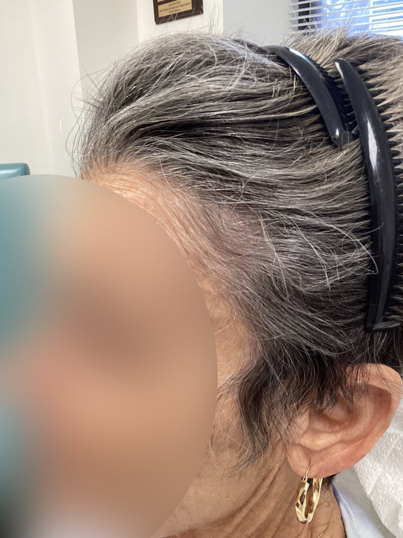Low Level Laser Therapy Before & After Gallery - Patient 489051 - Image 2