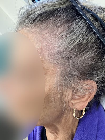 Telogen Effluvium Before & After Gallery - Patient 385900 - Image 1