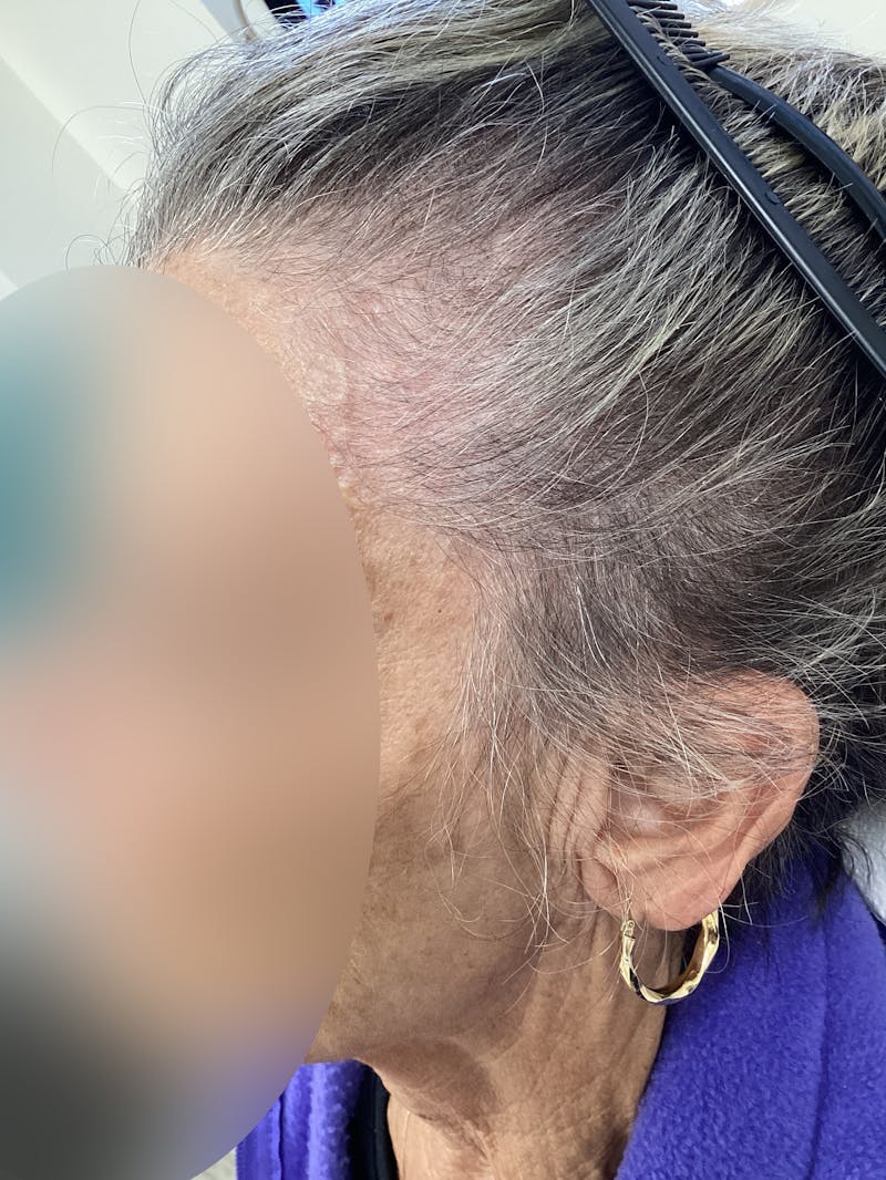 Low Level Laser Therapy Before & After Gallery - Patient 489051 - Image 1
