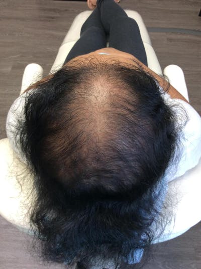 Scarring Alopecia Before & After Gallery - Patient 681932 - Image 2