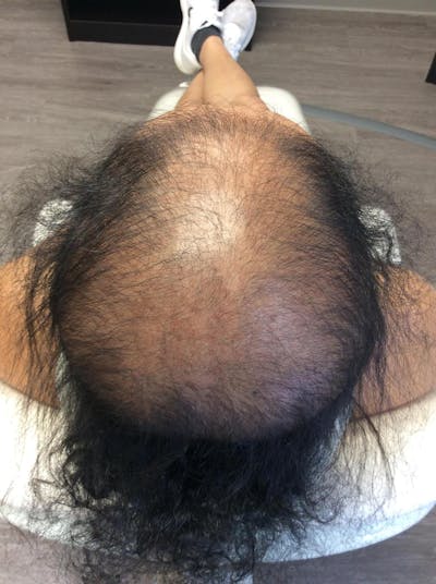 Scarring Alopecia Before & After Gallery - Patient 681932 - Image 1