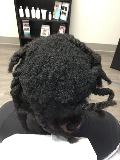 Scarring Alopecia Before & After Gallery - Patient 134434 - Image 2