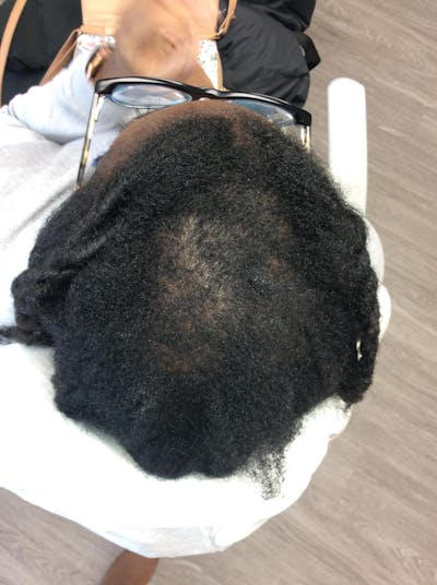 Scarring Alopecia Before & After Gallery - Patient 134434 - Image 1