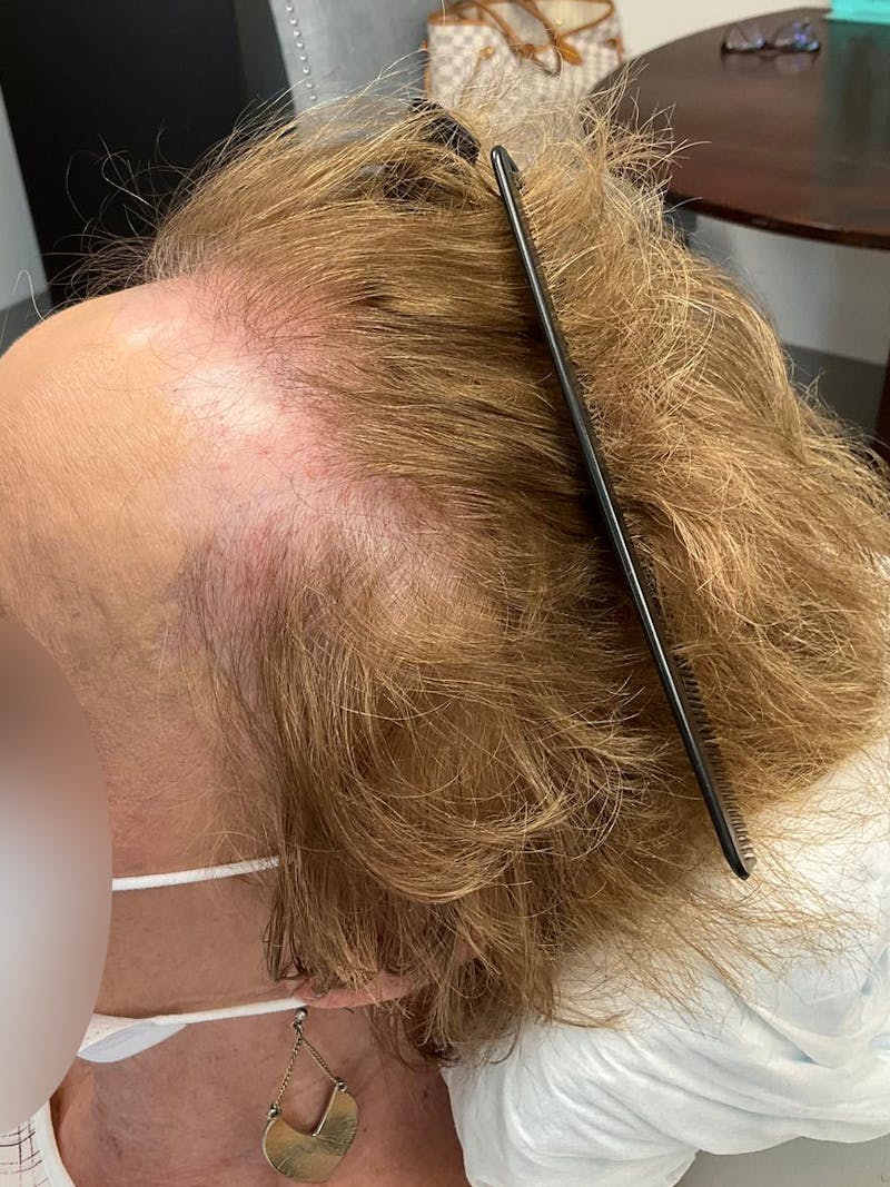 Scarring Alopecia Before & After Gallery - Patient 396978 - Image 2