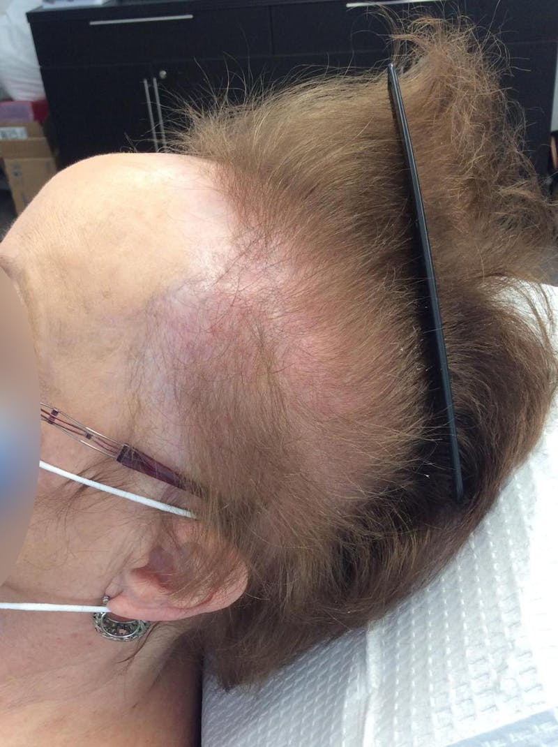 Scarring Alopecia Before & After Gallery - Patient 396978 - Image 1