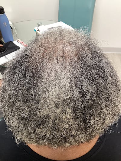 Scarring Alopecia Before & After Gallery - Patient 269086 - Image 2
