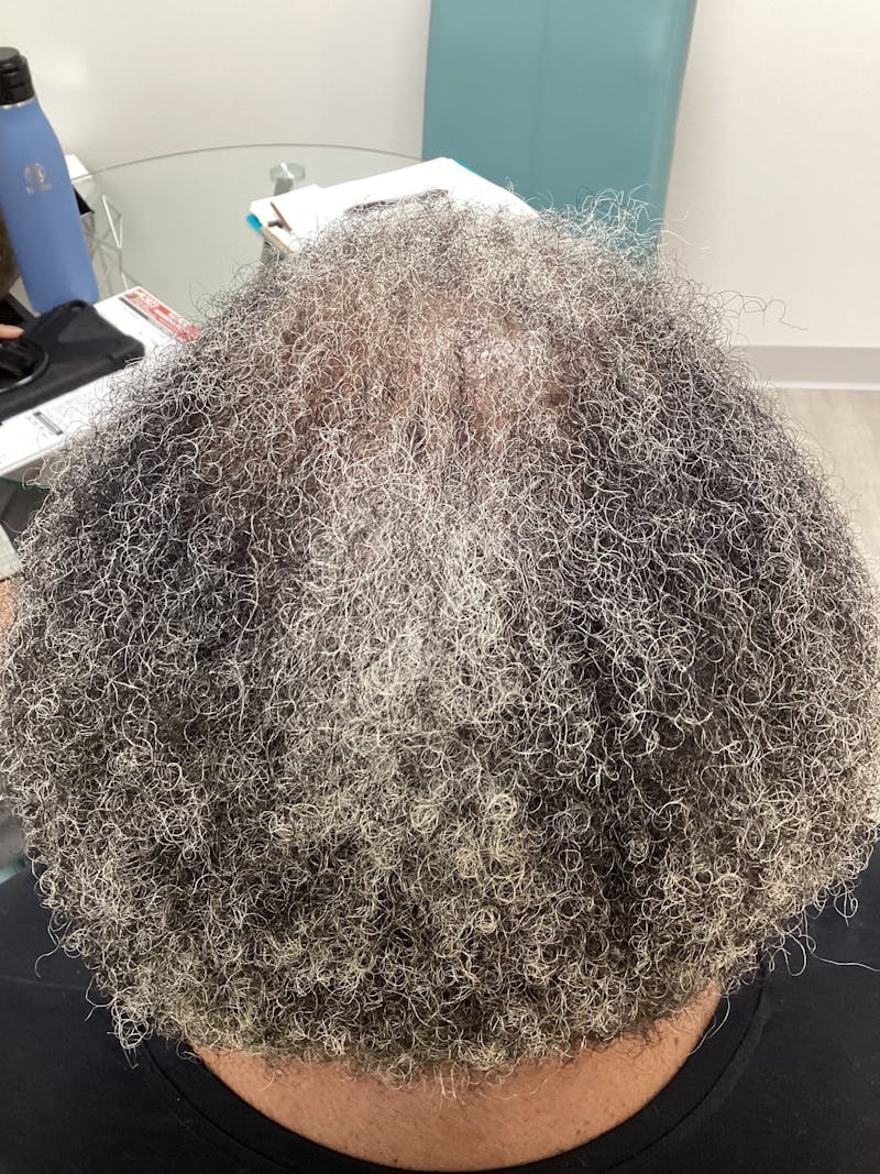 Medications Before & After Gallery - Patient 635582 - Image 2