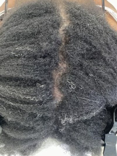 Low Level Laser Therapy Before & After Gallery - Patient 402375 - Image 2