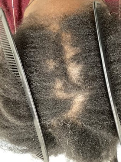 Low Level Laser Therapy Before & After Gallery - Patient 402375 - Image 1
