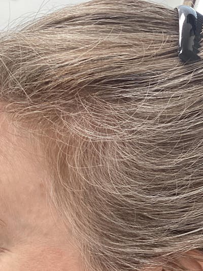 Scarring Alopecia Before & After Gallery - Patient 201213 - Image 2